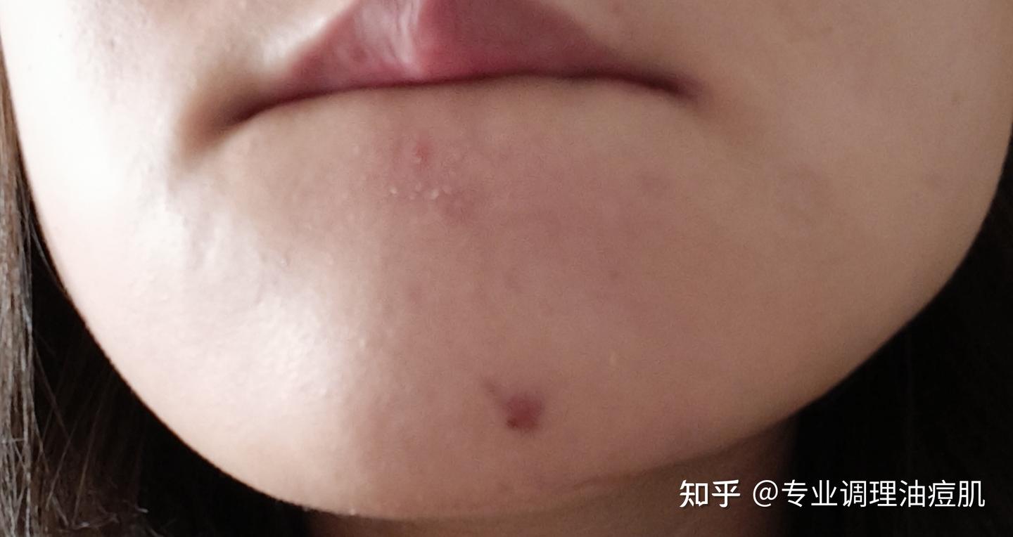 知乎05-天生敏感肌，下巴额头反复闭口的调理之路。 - 知乎