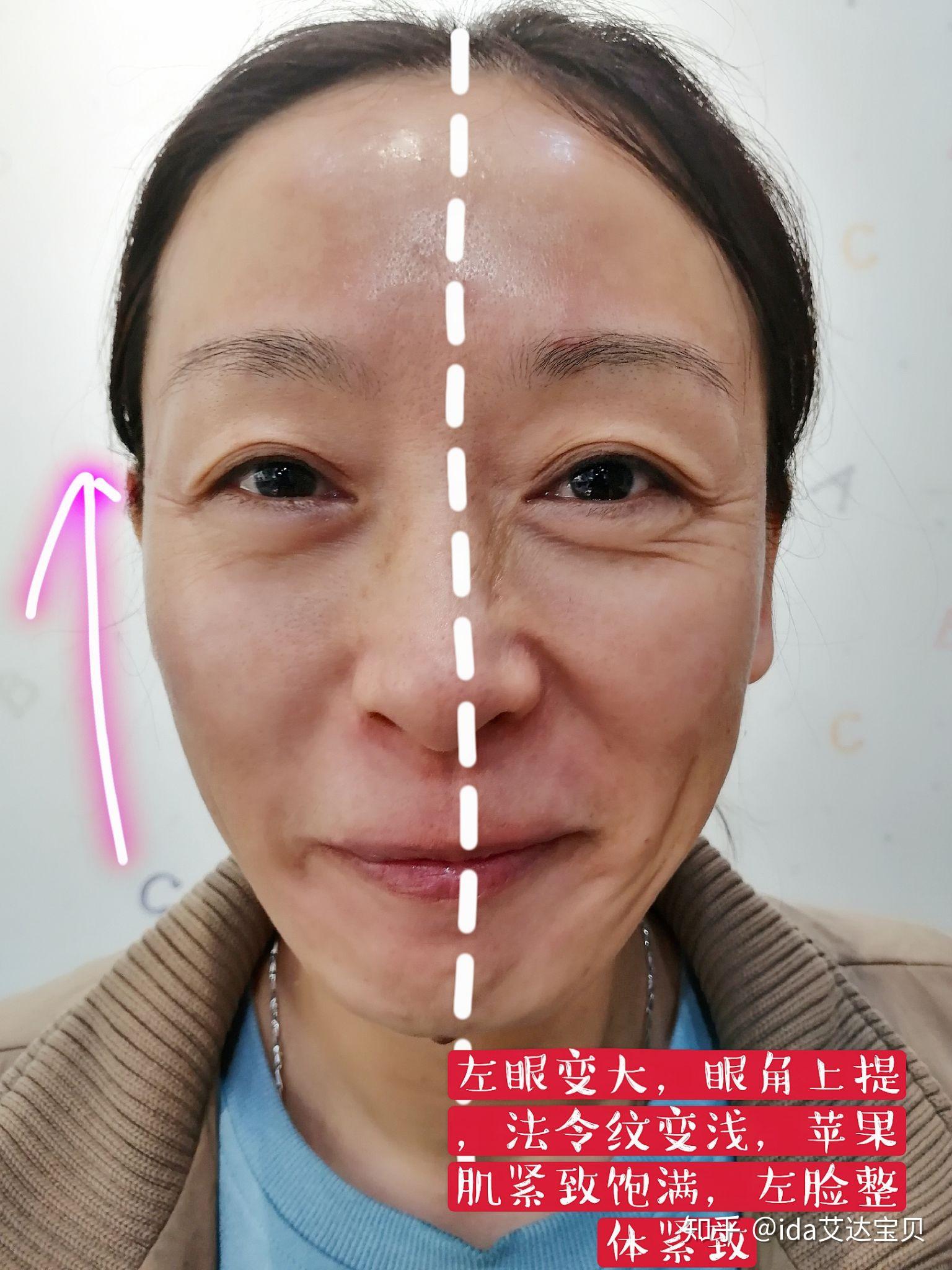 皱纹是不是只能依靠医美才能去除?