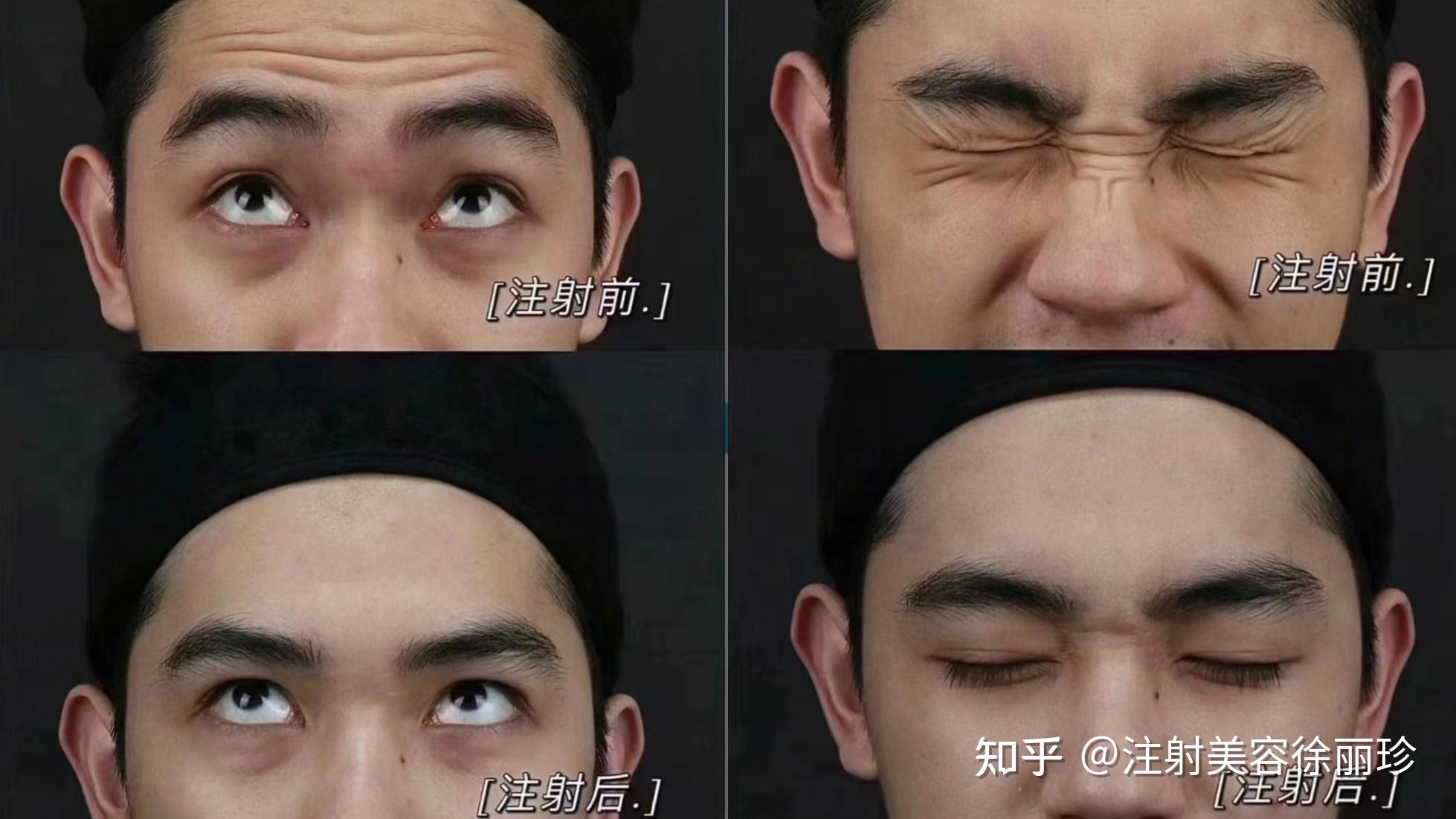 面对不同皱纹应该如何解决?除皱方法你都选对了吗? - 知乎