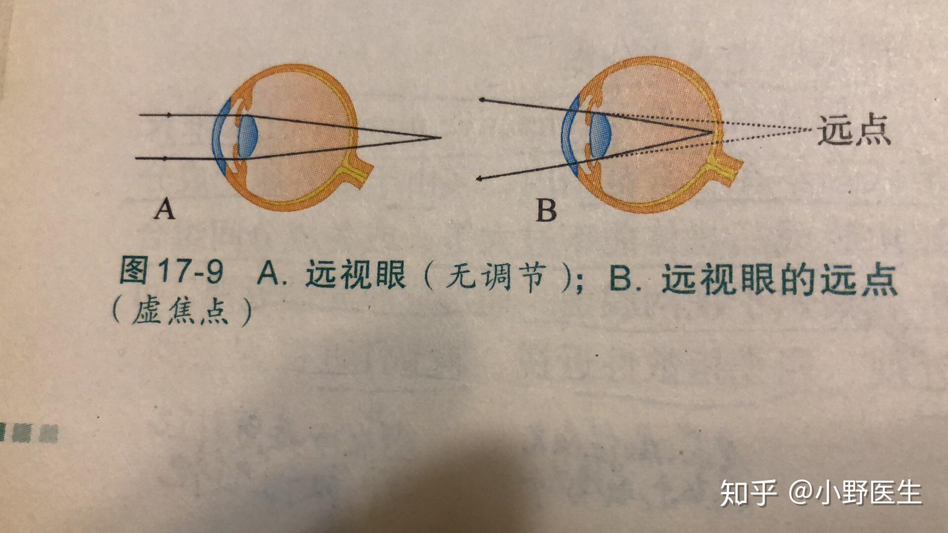 老花和远视的那些事