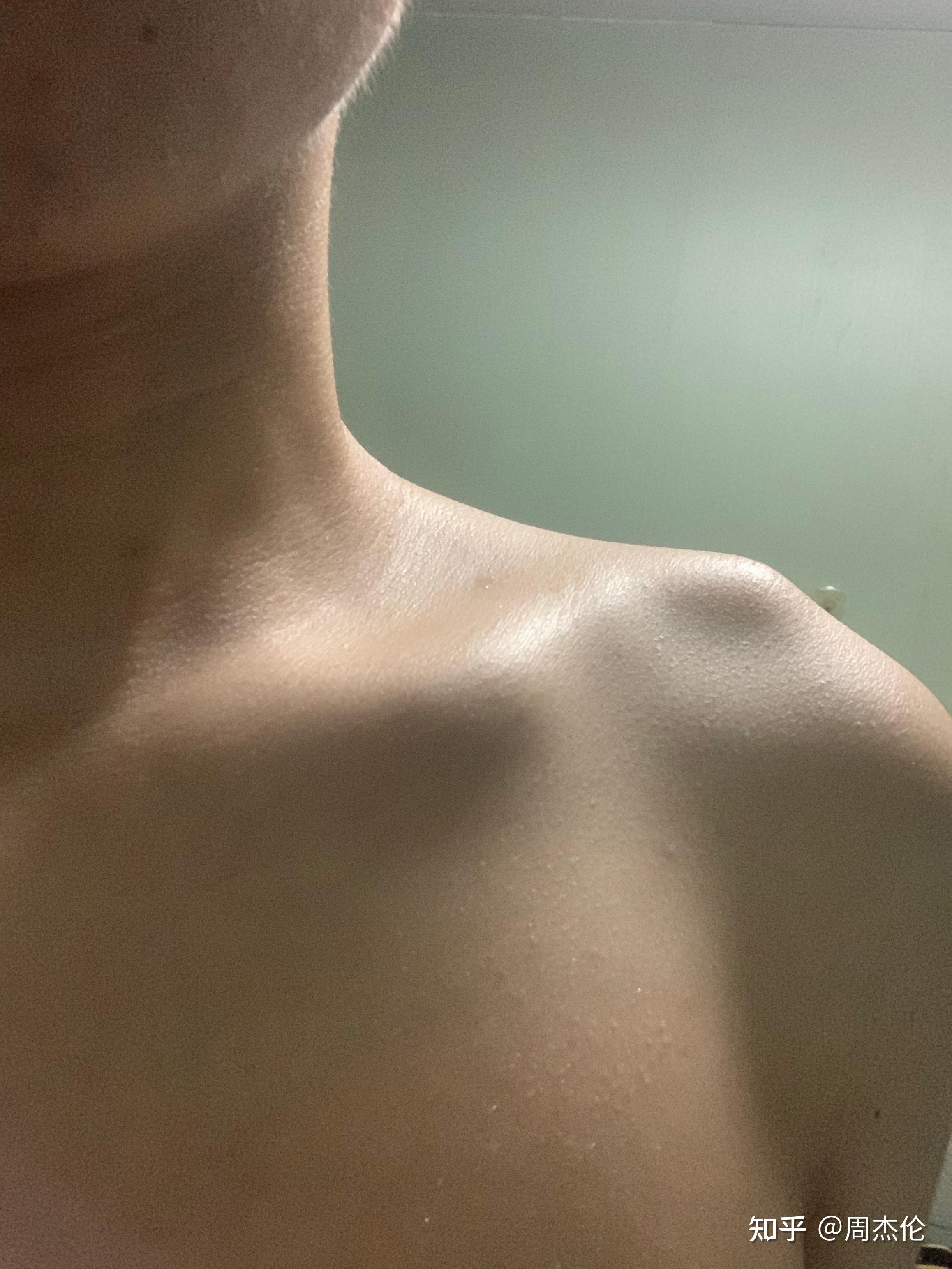 锁骨突出不正常,有人知道吗?