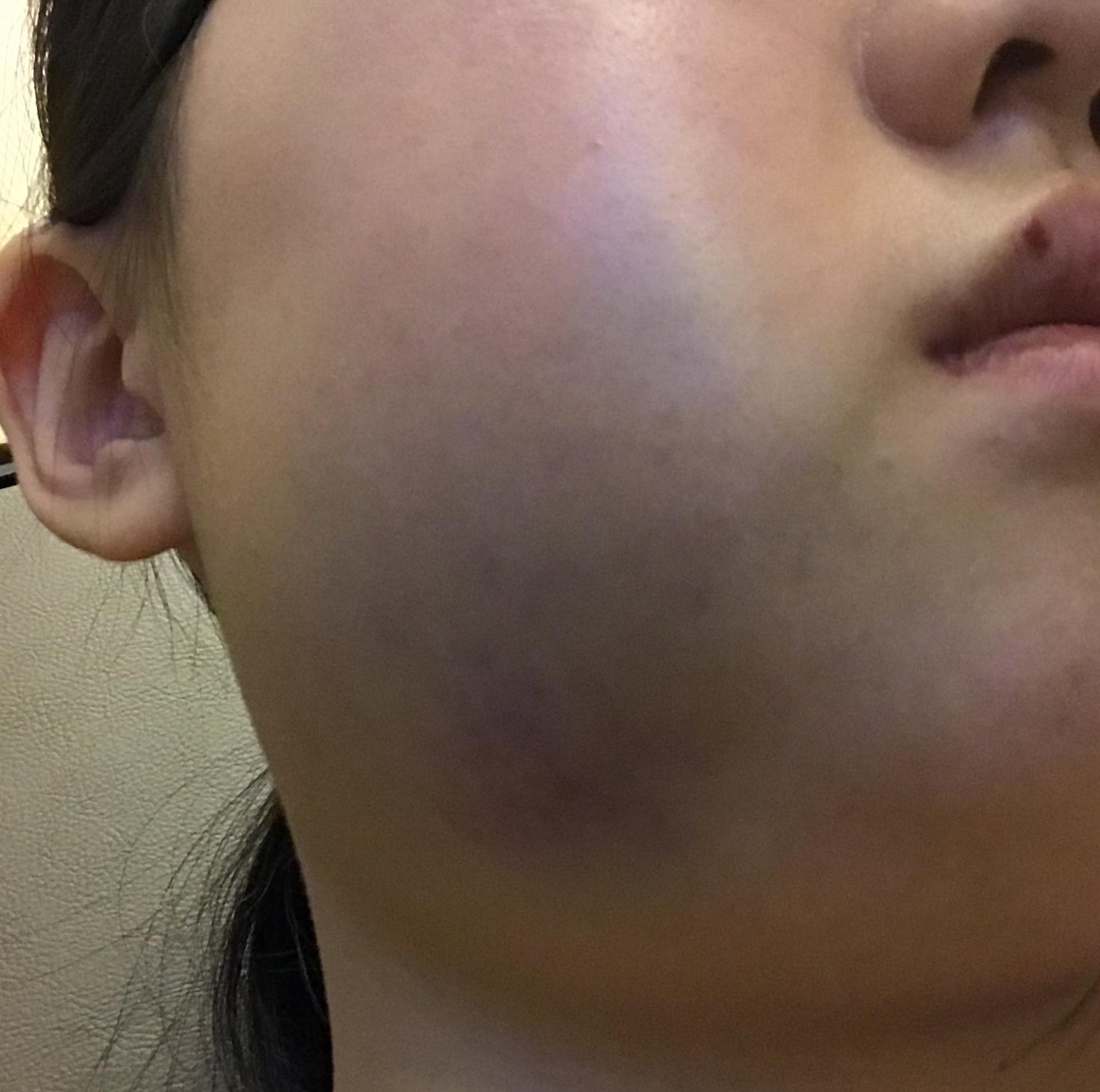 拔完智齿半天后脸肿得厉害