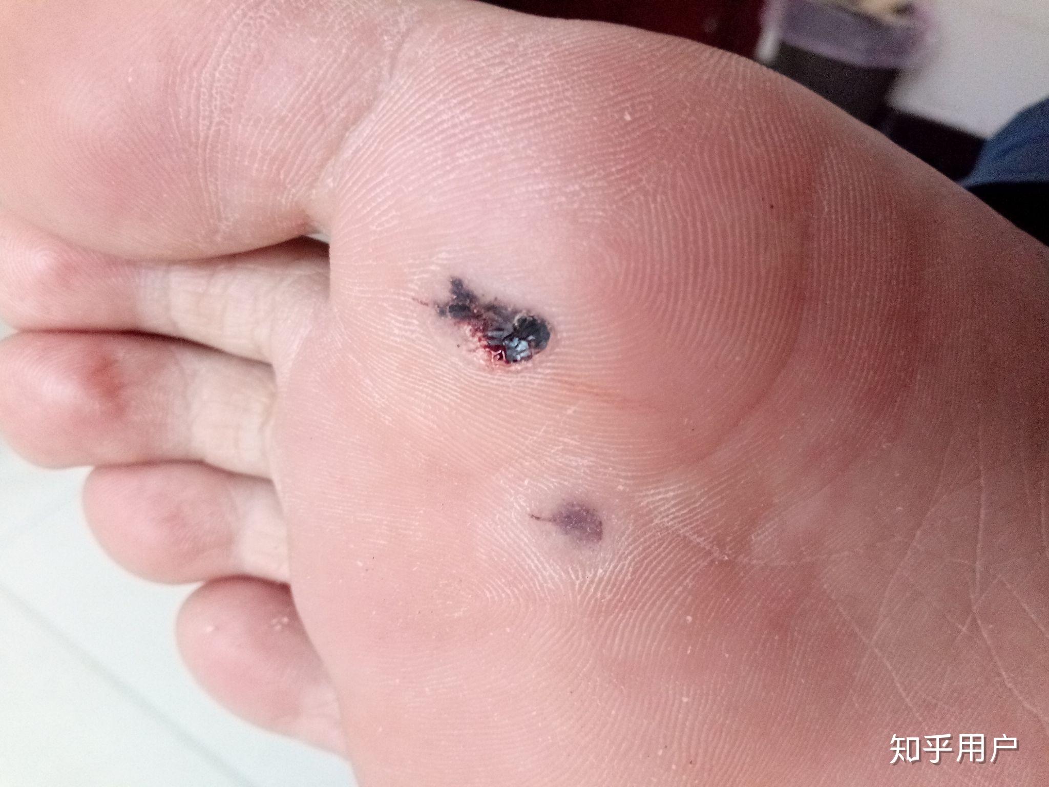 跖疣的自愈性大吗