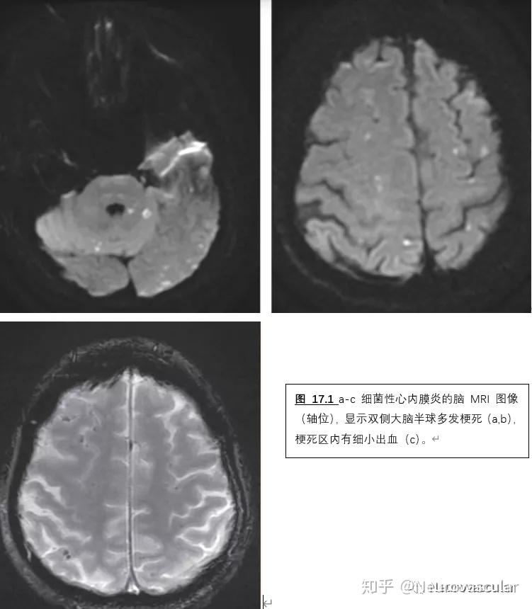 二,心源性脑栓塞的内科治疗(2)