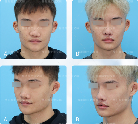 兔唇是罪吗?每次脱下口罩都被人嘲笑,怎么才能变得像正常人一样? - 知乎