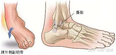 部分脚踝无力是来自于曾经崴过脚,或者专业术语叫做踝外侧副韧带撕裂