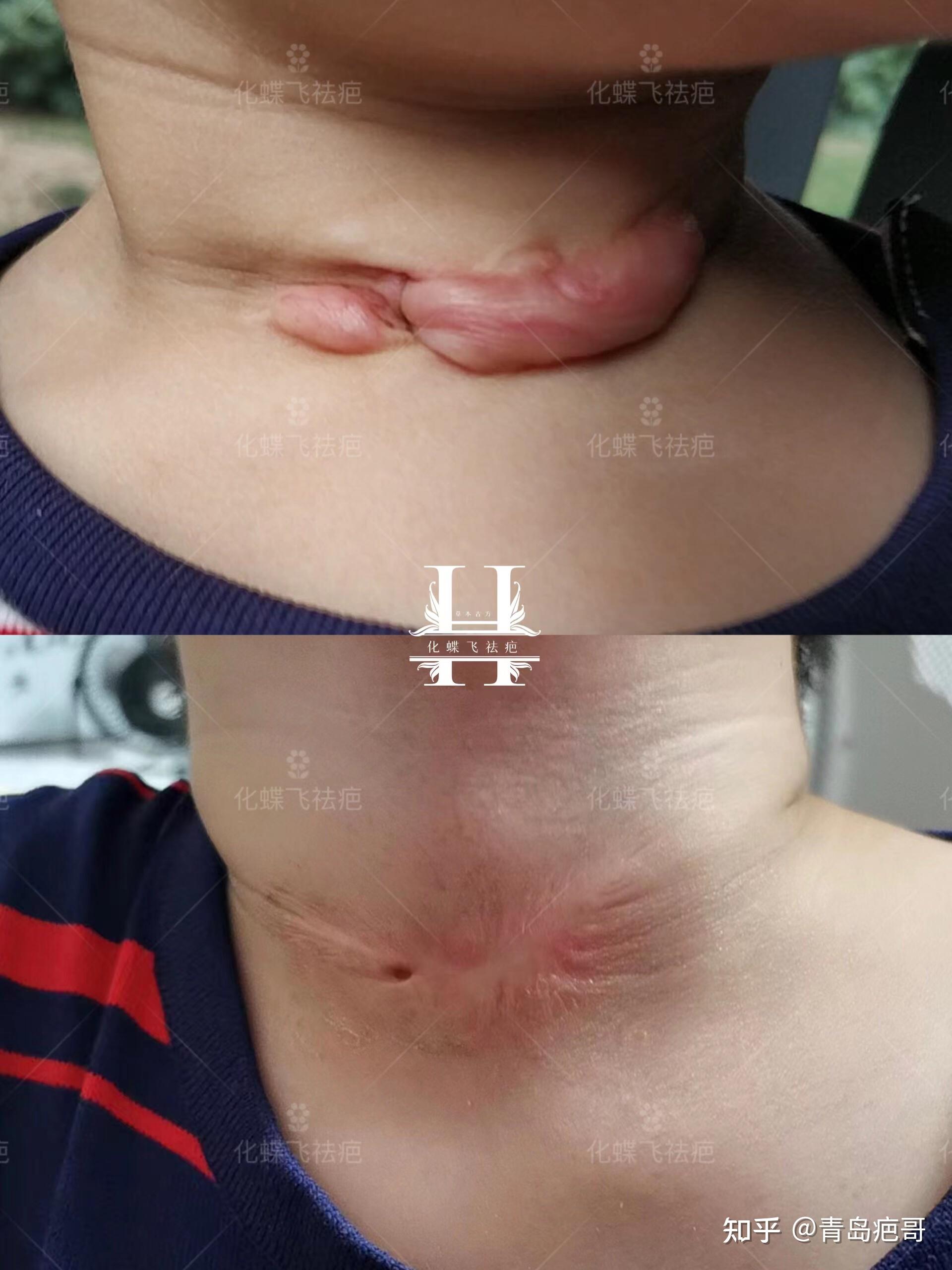 3岁宝宝脖子位置重度烫伤增生疤痕