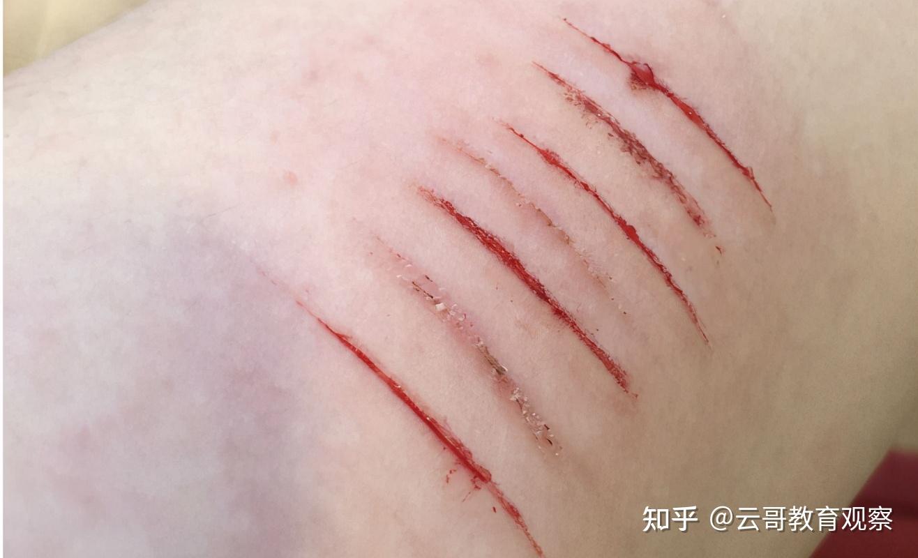 手腕刀疤真实图片图片