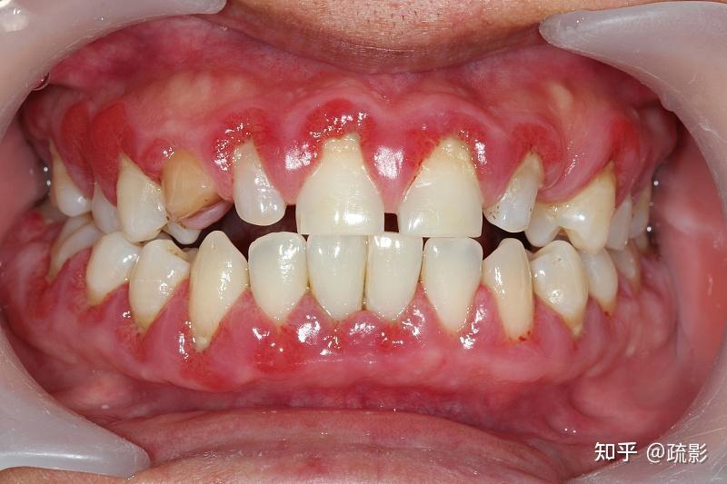 如何拯救牙龈出血问题?牙龈容易出血还能用电动牙刷?