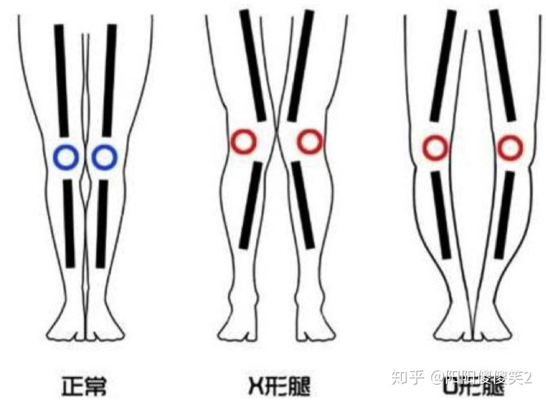 OX型腿，小腿外翻，X型腿，原来练这个部位就可以把腿变直！_哔哩哔哩_bilibili