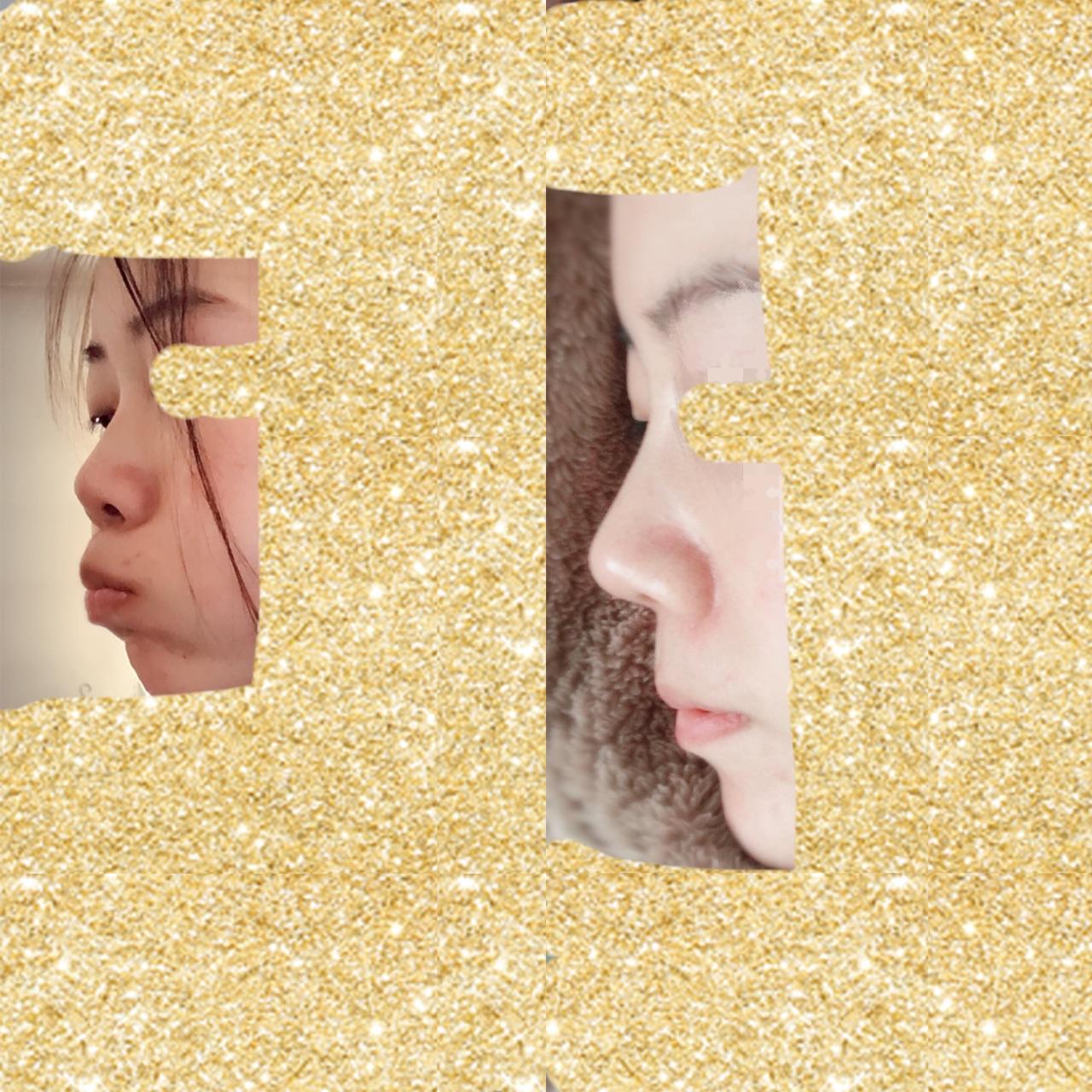 关于垫鼻梁的纪录和分享5