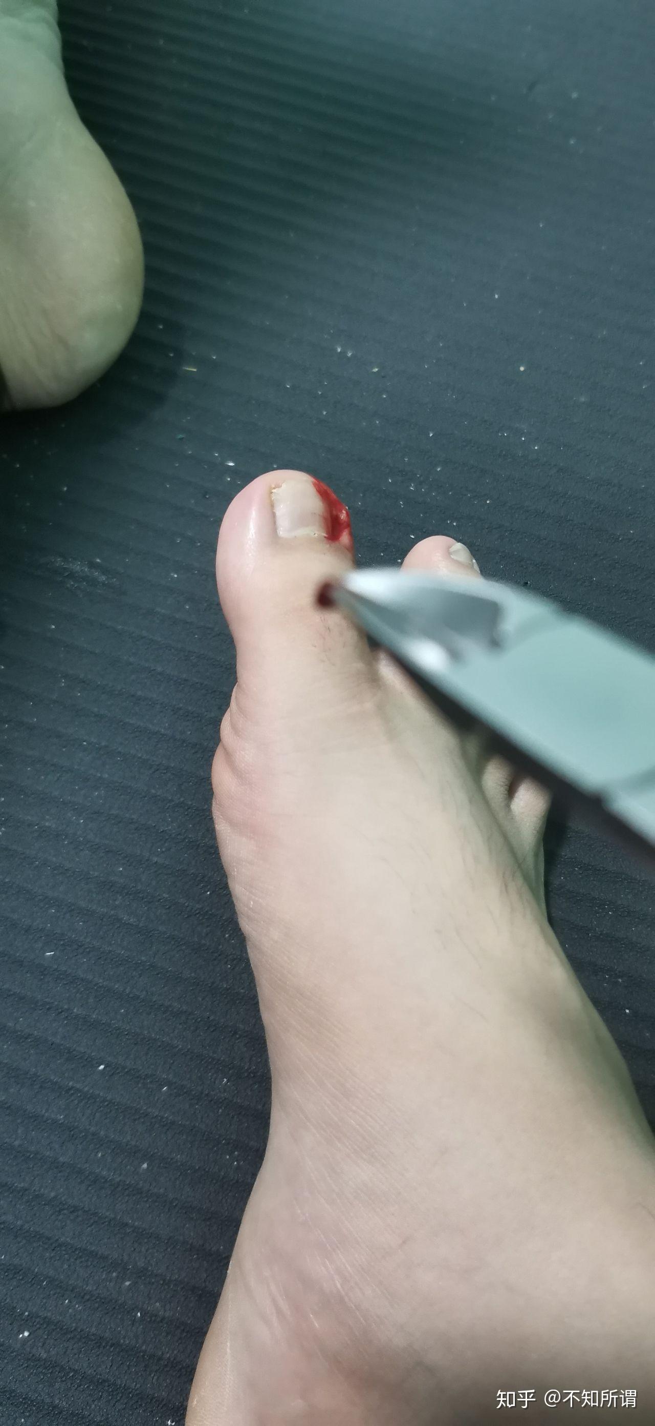 这是人能忍受的痛苦吗之甲沟炎