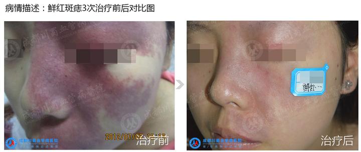 治疗胎记新技术-多源色素层析治疗系统 - 知乎
