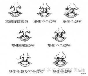 兔唇宝宝?你了解多少? - 知乎