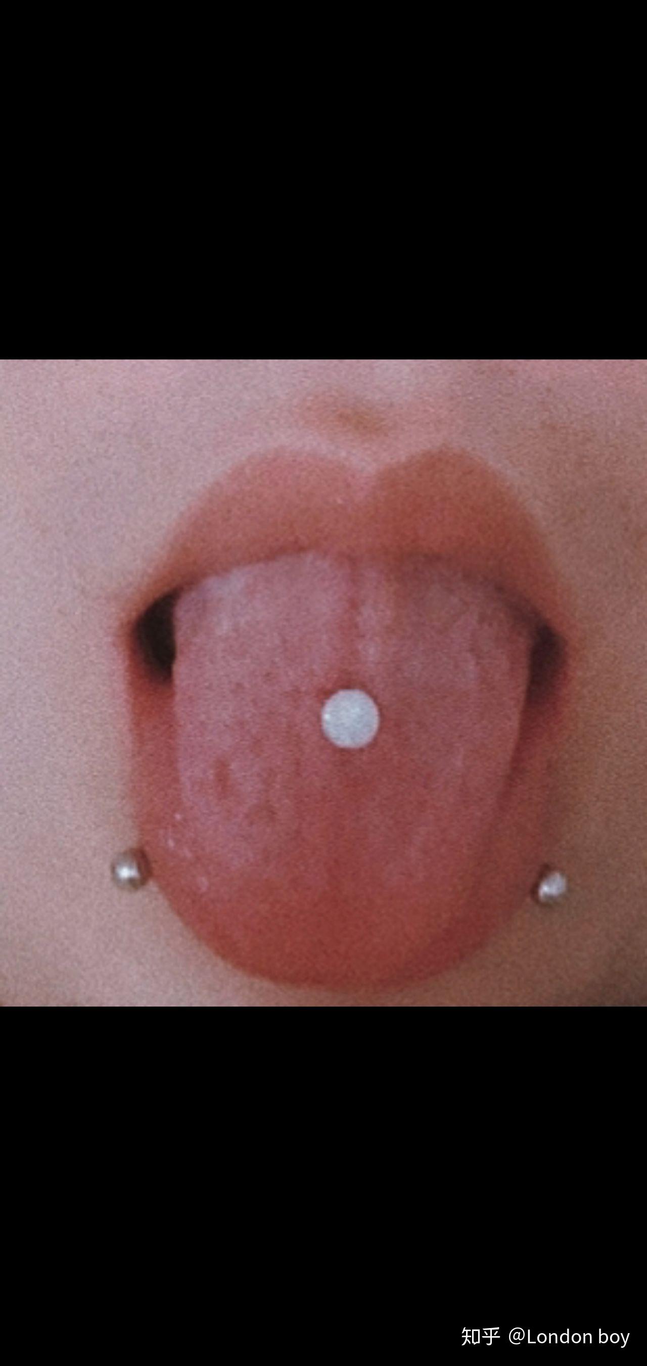 打完舌钉之后舌头有个小坑? - 知乎