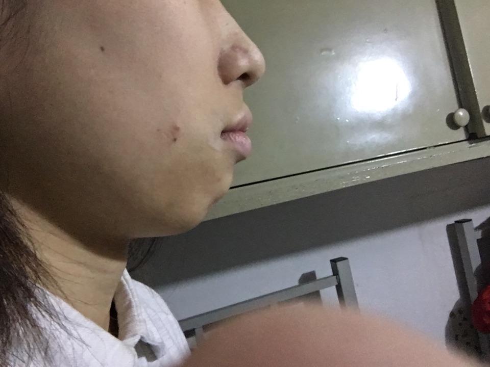 不笑的时候下巴有一块肉嘟起来从小就有很困扰请问有何建议有图