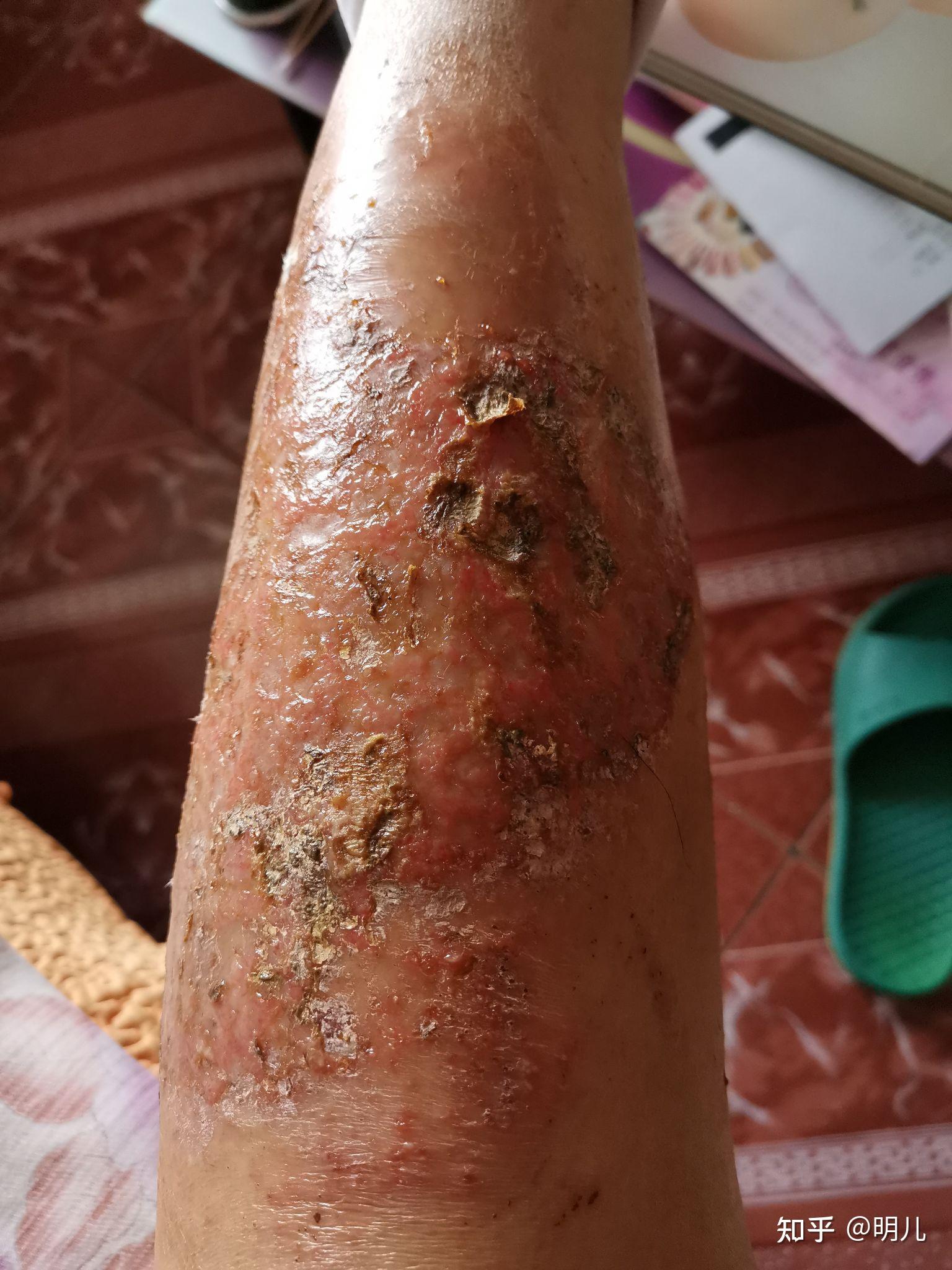 与湿疹的战斗经历