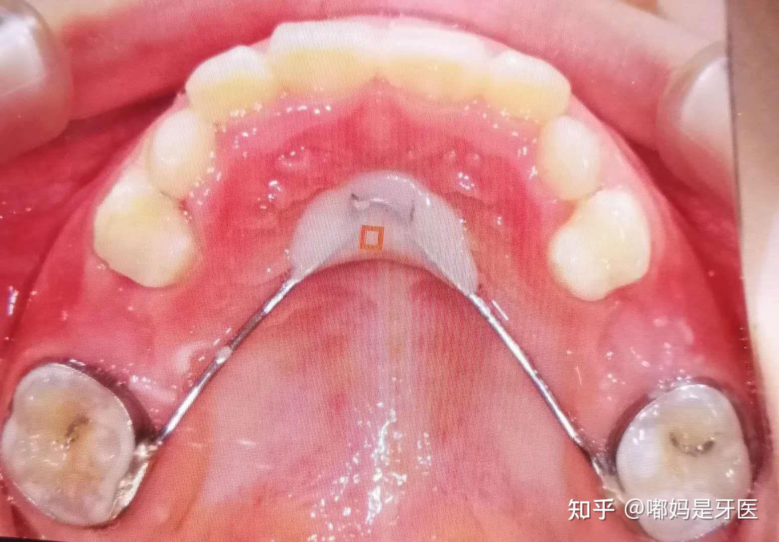 缺隙保持器的複診和注意事項粘接在牙齒上的缺隙保持器不能進食太硬太