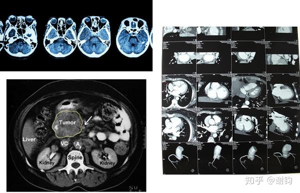 现代医学成像(3)——CT(基本原理与图像重建) - 知乎