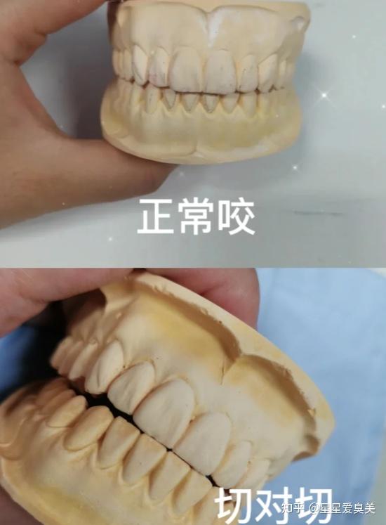 牙齿对刃必须要矫正吗?