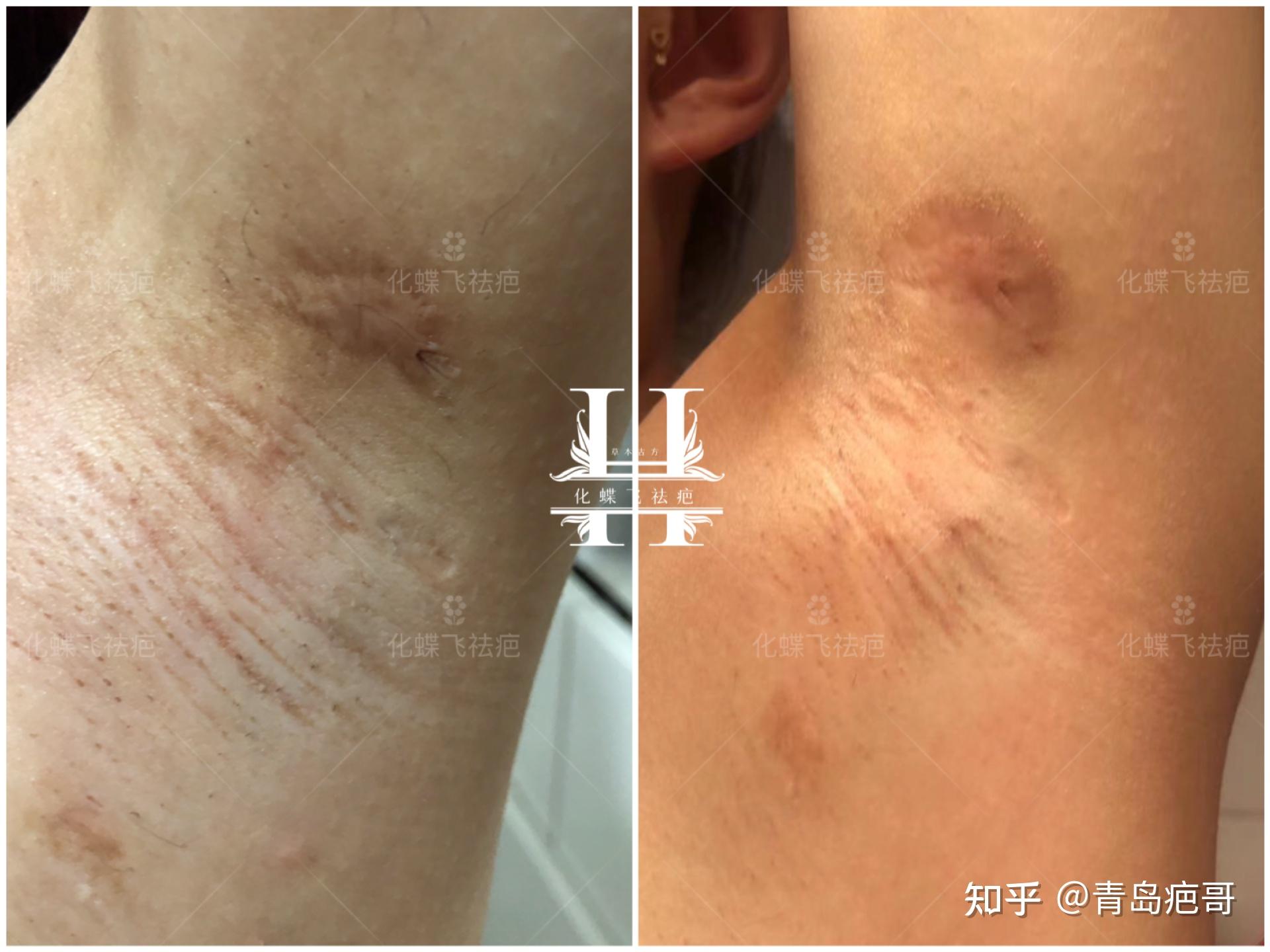 七八年的腋下手术疤痕