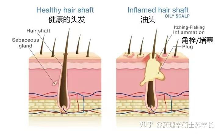 男生头屑多到像下雪，二硫化硒用了、土方子也用了，没效果！有什么牛逼的方法能快速去头屑的吗？【医学硕士】教你3步，解决男生头皮屑问题，一个月还原 ...