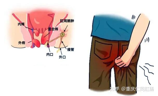 重庆治疗肛门最好的医院?痔疮外痔肉球如何消除? - 知乎