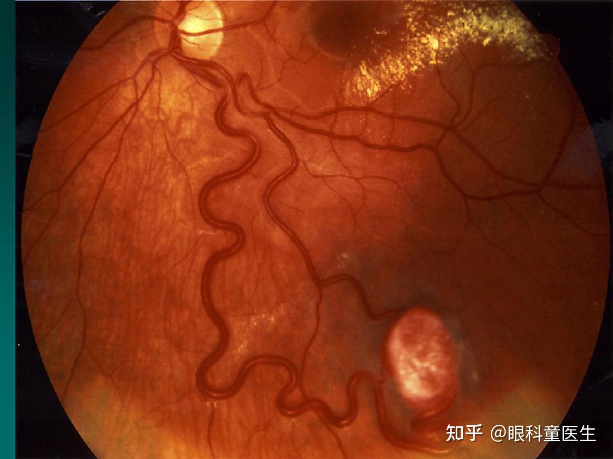 视网膜海绵状血管瘤是什么样的？ - 知乎