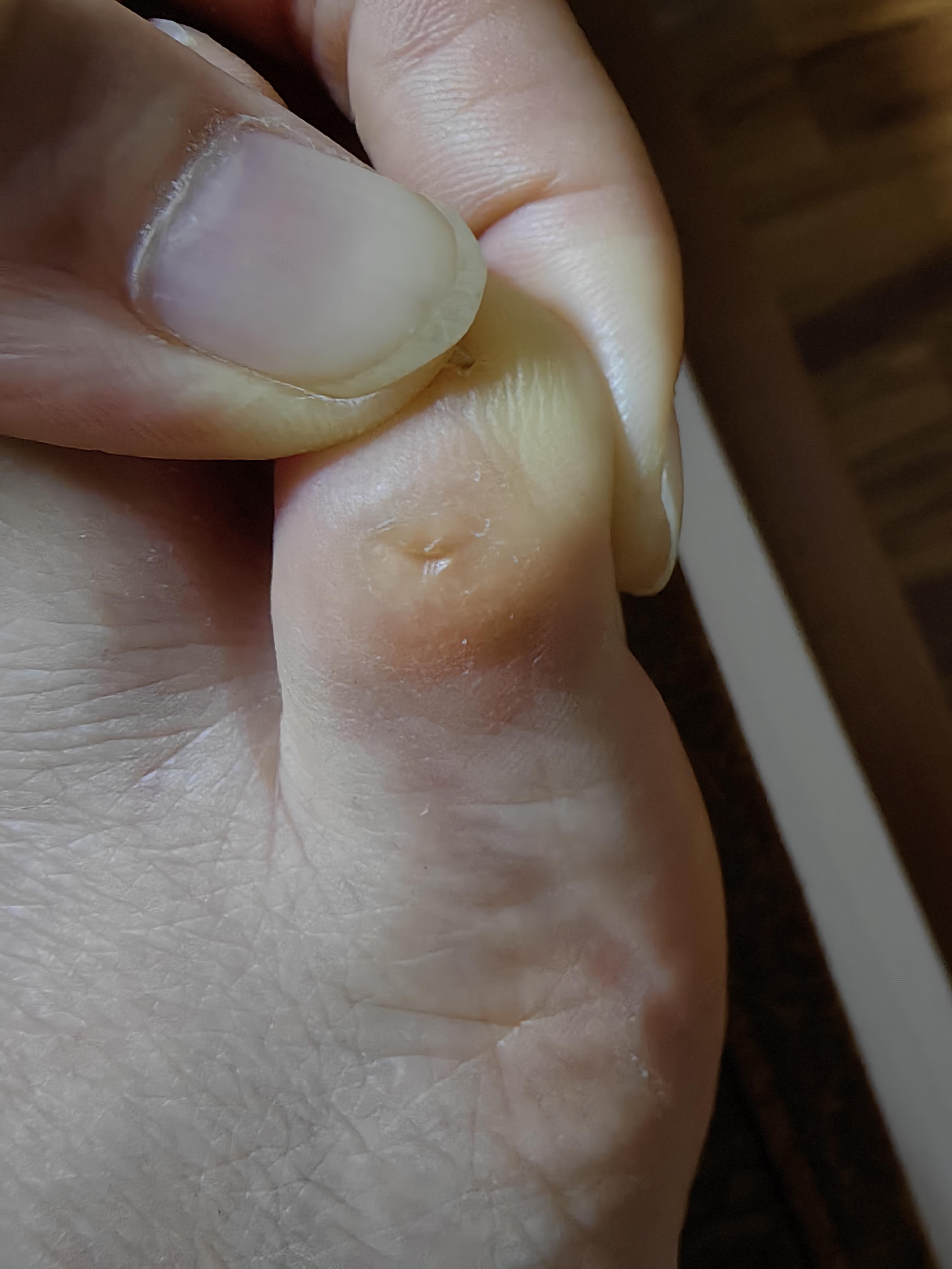 右脚【小脚指】疼