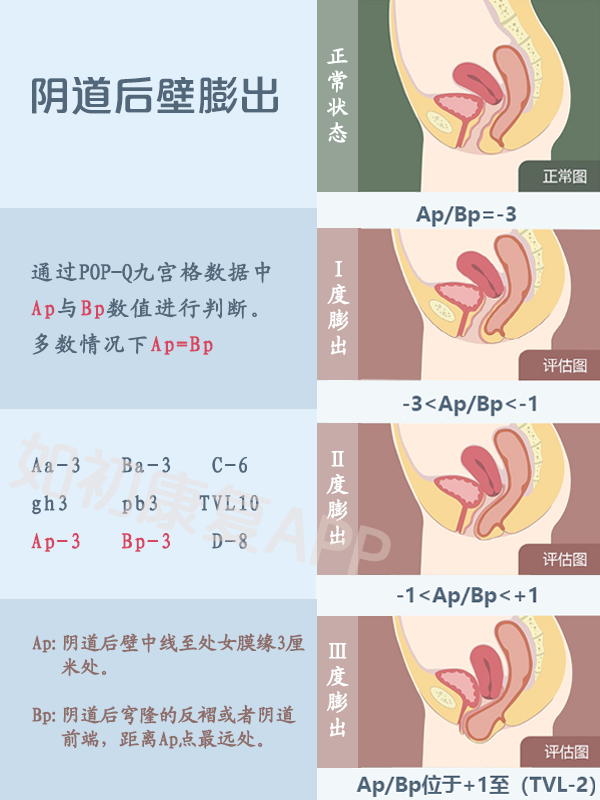 產後子宮脫垂程度陰道壁膨出程度判斷方法