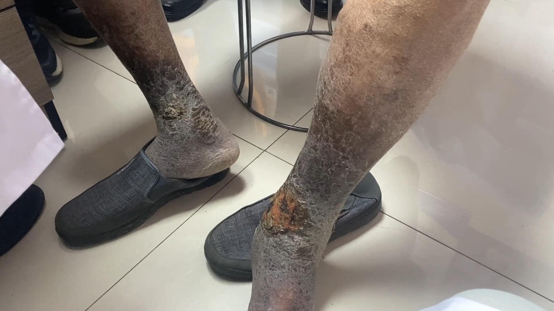 双腿发黑溃疡结痂后以为是愈合但这不叫真正的愈合