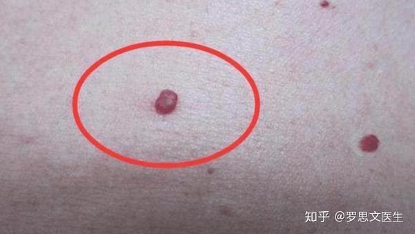身上突然长了很多小红痣是什么原因?很多人隐私部位也会有 - 知乎
