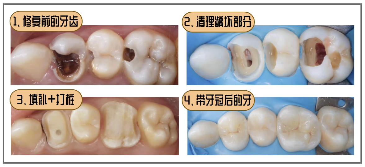 蛀牙补牙过程图解图片