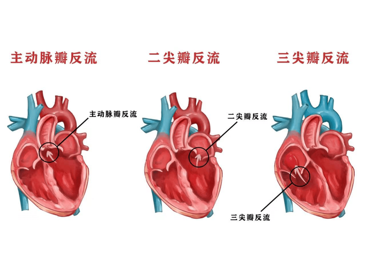 在问心剧中经常提到的二尖瓣三尖瓣主动脉瓣返流是怎么回事是心脏病吗