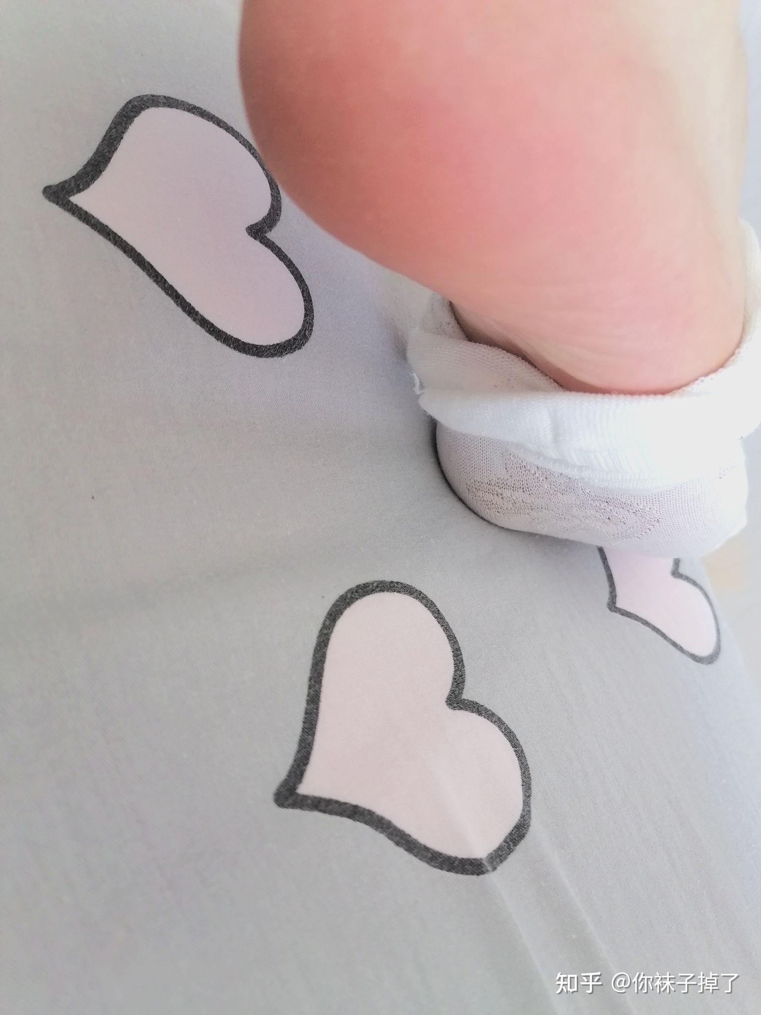 正常人脚后跟是什么颜色? - 知乎