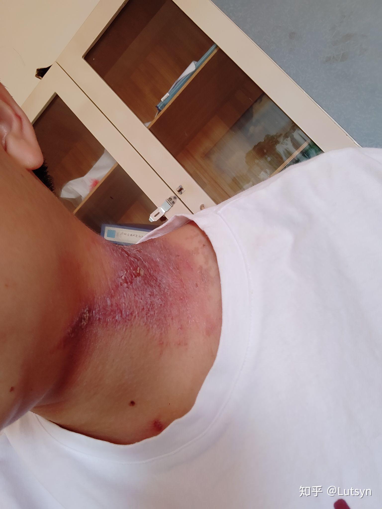 隐翅虫造成的伤口有什么特点