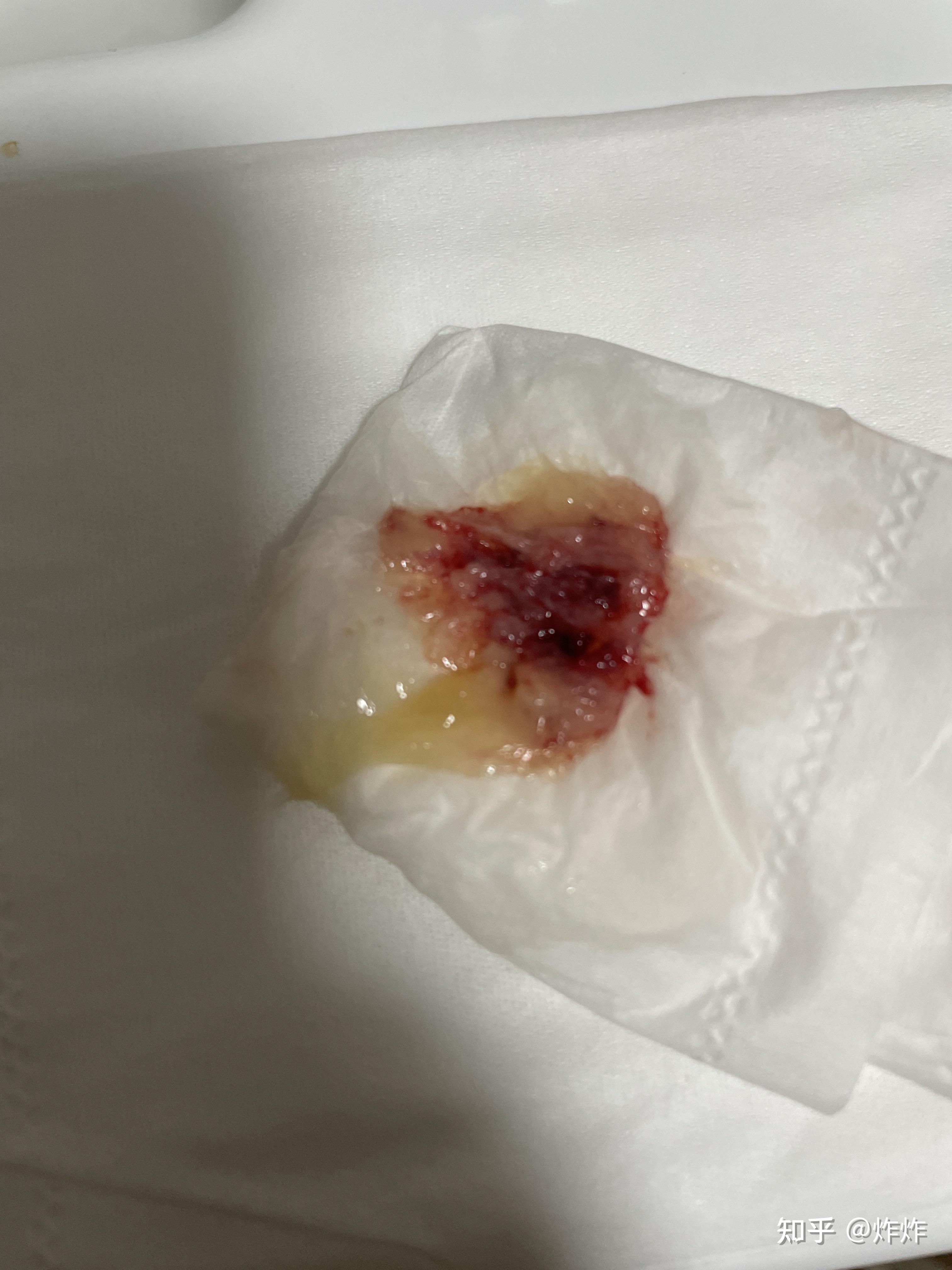 为什么每次感冒都能从鼻腔吸出块状物