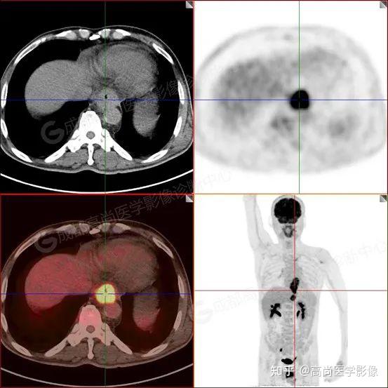 食管癌PET/CT诊断价值【高尚医学影像】 - 知乎