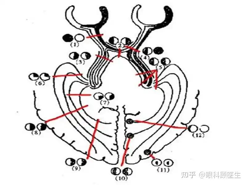 青光眼鼻侧阶梯图片