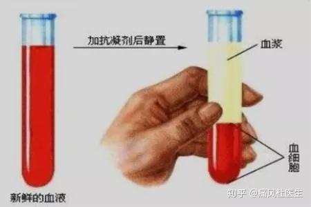 “为啥我血沉偏高啊?没啥问题吧......”类风湿患者如何降低血沉? - 知乎