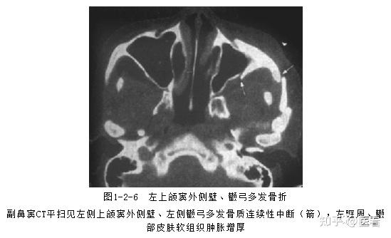 转给临床医生 车祸 脑出血 这些急诊疾病一定要开ct 知乎