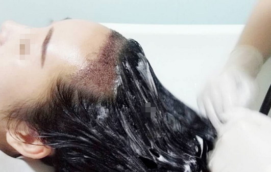 种植发际线安全吗,为什么几乎没见过女明星做