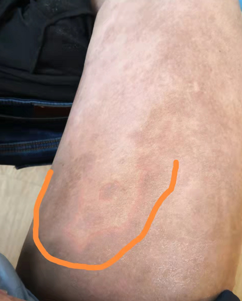 结节性血管炎的患友们,你们是怎么坚持的? - 知乎