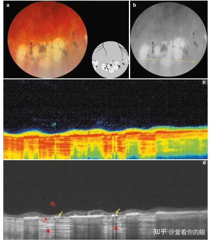图8 铺路石样变性眼底及oct表现视网膜周边部变性的治疗临床工作中,可