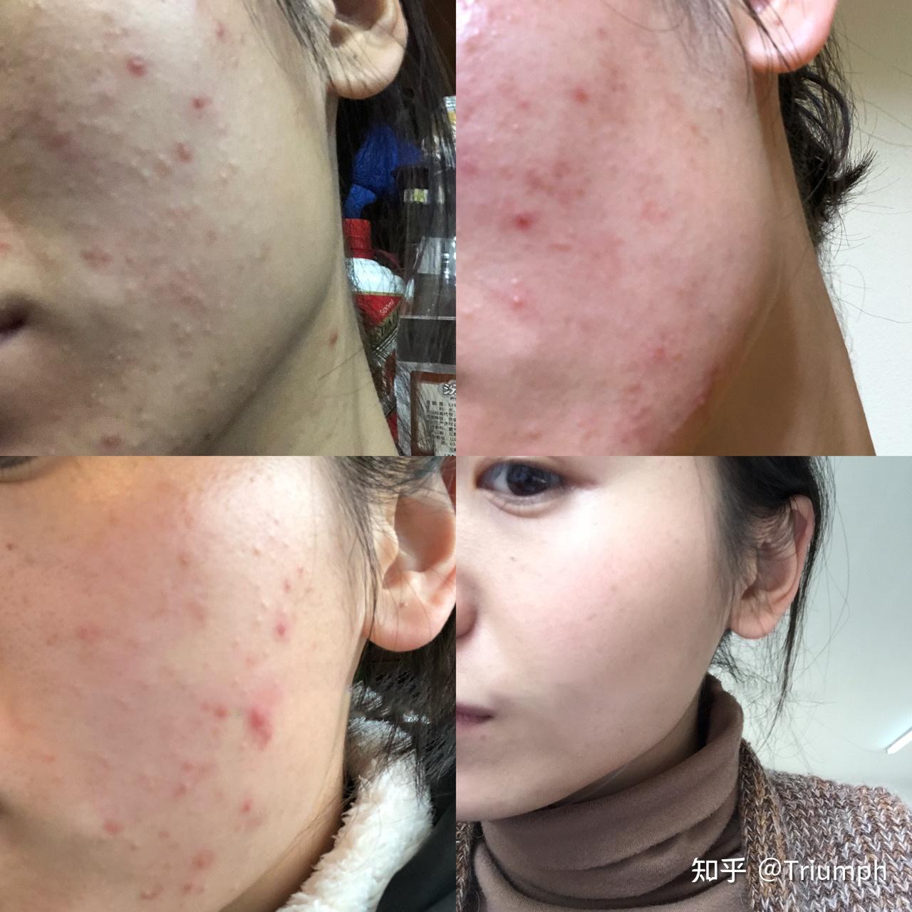皮肤科规培生告诉你,为什么持续长闭口时医生会推荐刷水杨酸?