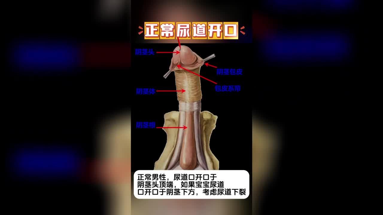 先天性尿道下裂什么模样?