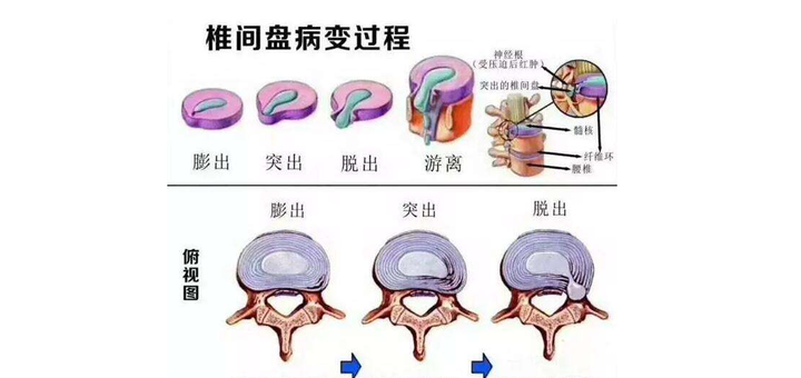 中医腰椎养生方法有哪些(中医腰椎养生方法有哪些图片)