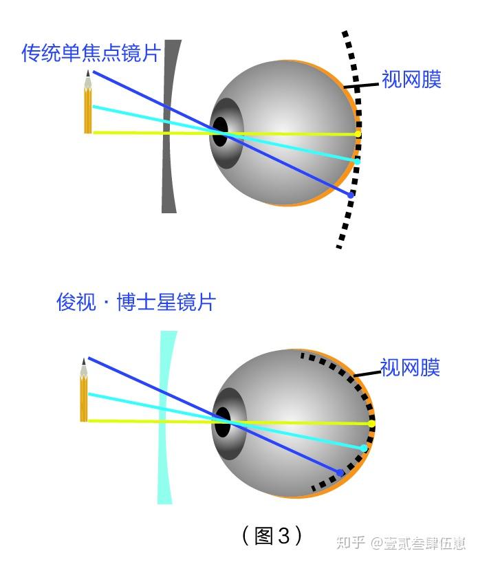 俊视镜片【科普】全焦,环焦,离焦镜片的区别