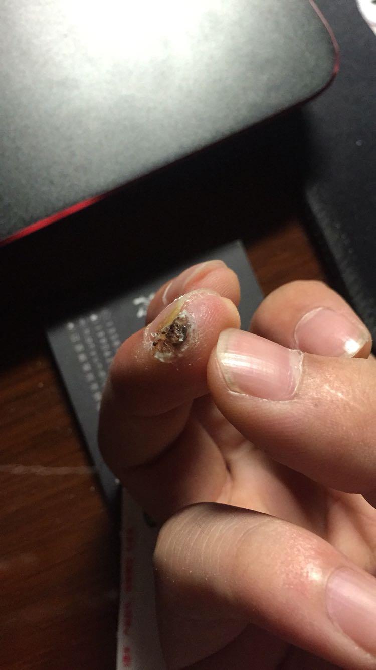 我的天,是甲周疣吗,如果不去手术会扩散到整个指甲吗,好可怕?