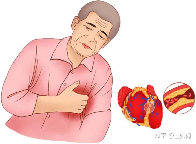 大脑缺血容易导致脑卒中;慢性缺氧会导致心肌血管萎缩,心脏收缩功能
